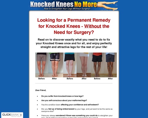 Knocked Knees No More – How to Straighten Your Legs Without Surgery!